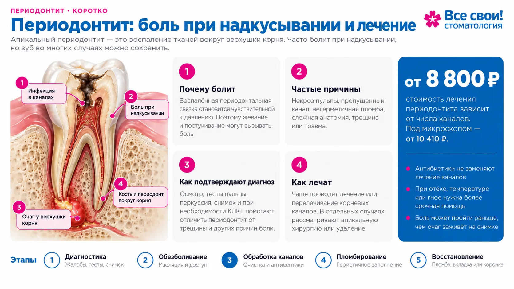 периодонтит зуба — боль при накусывании и лечение корневых каналов в Санкт-Петербурге